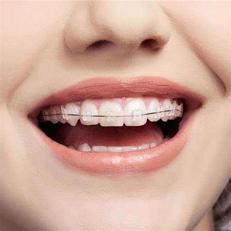 diş teli için hangi bölüm